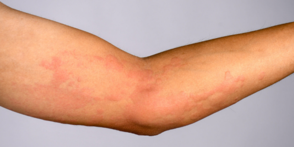 How to Know If You’re Having a Drug Reaction