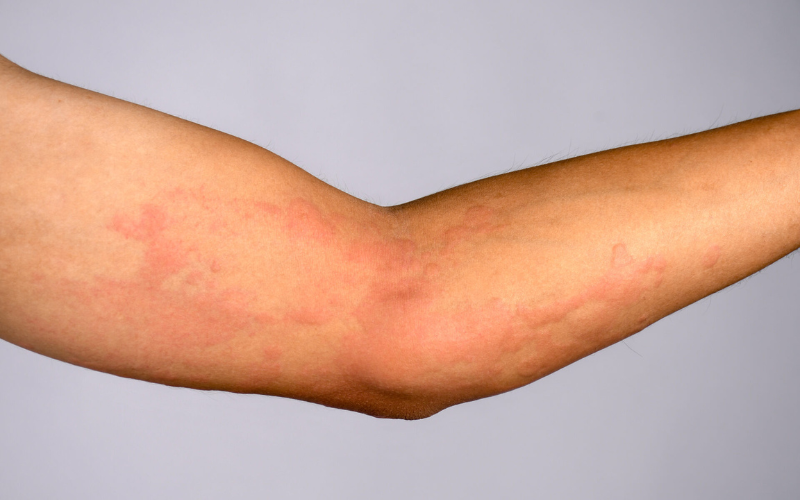 Drug Reaction Symptoms