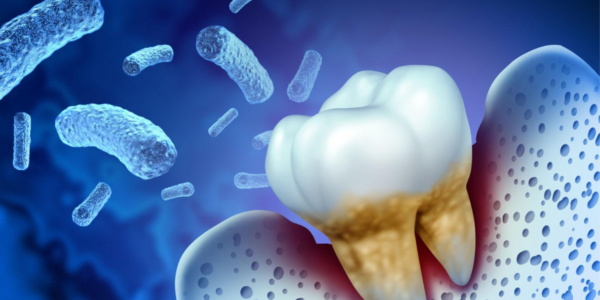 Antibiotics in Dental Care: When and Why They Are Prescribed